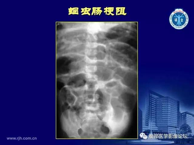 【PPT】急腹症