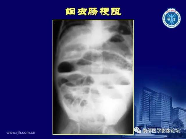 【PPT】急腹症