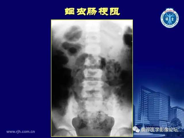 【PPT】急腹症