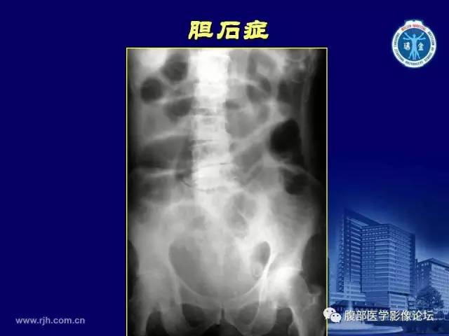 【PPT】急腹症