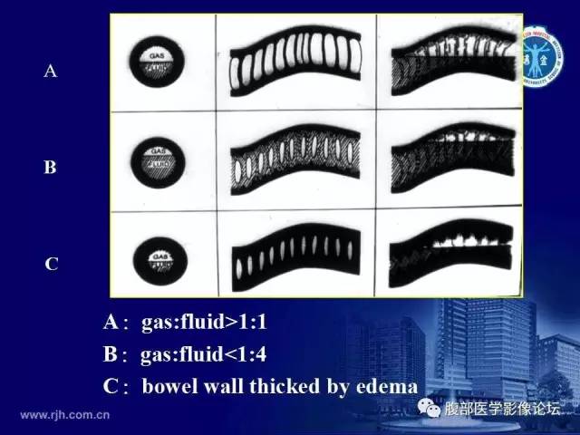 【PPT】急腹症