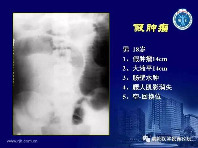 【PPT】急腹症