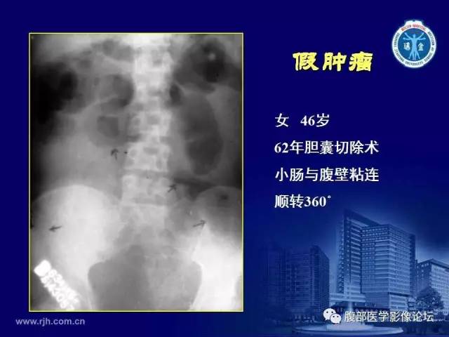 【PPT】急腹症