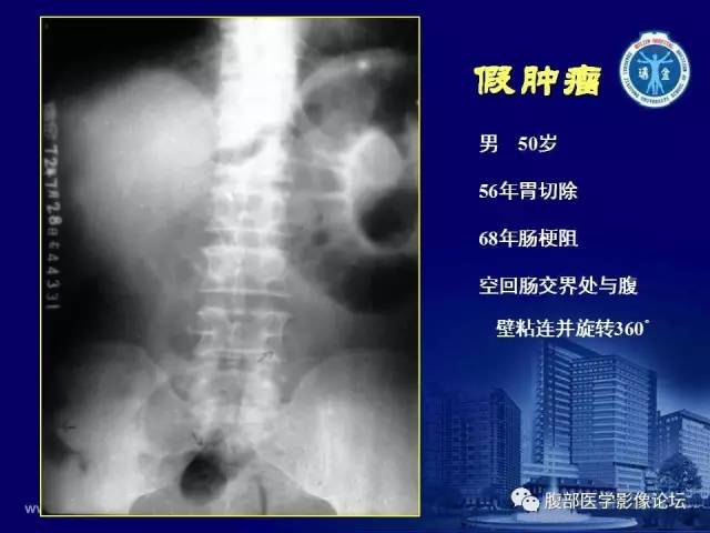 【PPT】急腹症