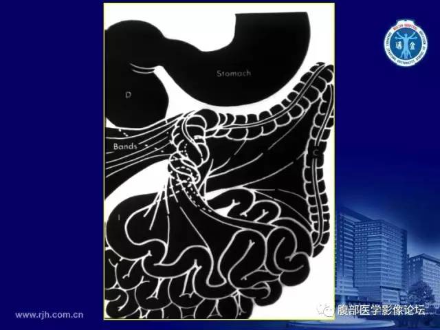 【PPT】急腹症