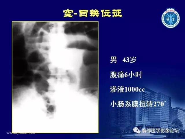 【PPT】急腹症