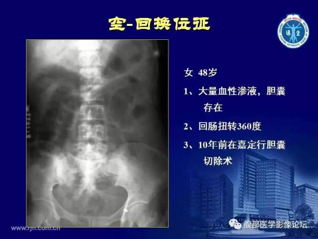 【PPT】急腹症