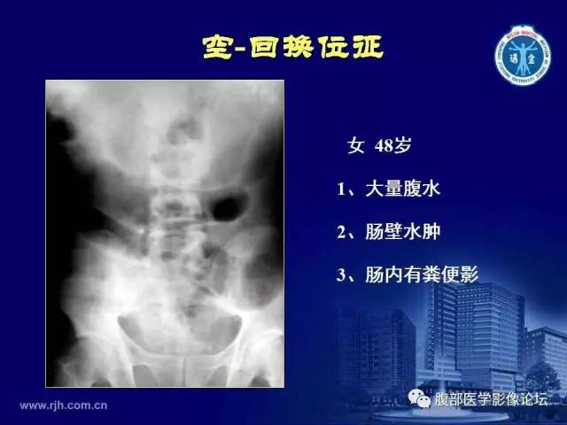 【PPT】急腹症