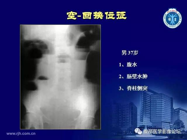 【PPT】急腹症