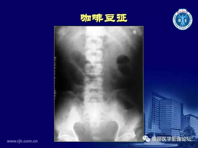 【PPT】急腹症