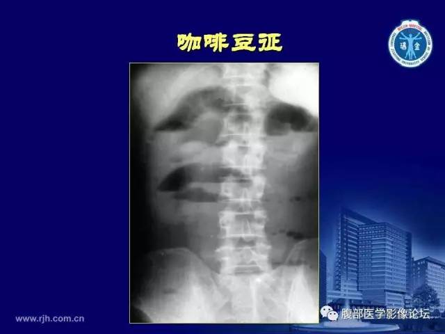 【PPT】急腹症