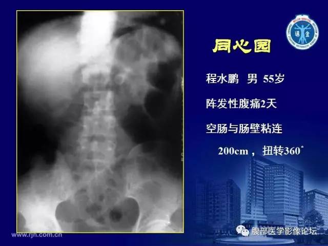 【PPT】急腹症