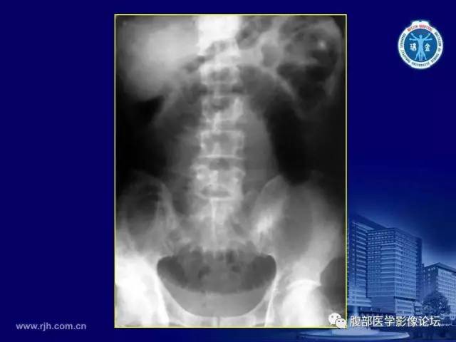 【PPT】急腹症