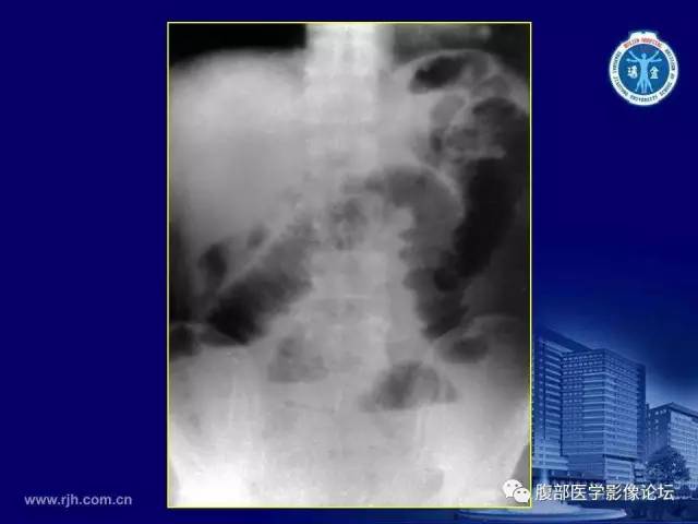 【PPT】急腹症
