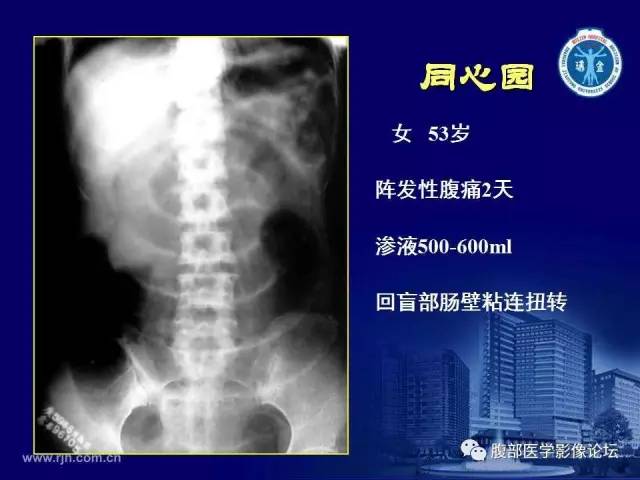 【PPT】急腹症