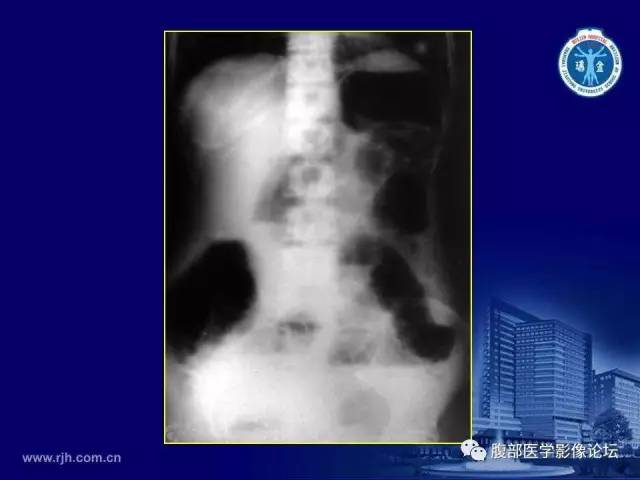 【PPT】急腹症