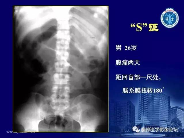 【PPT】急腹症