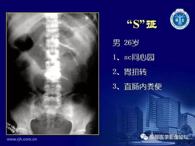 【PPT】急腹症