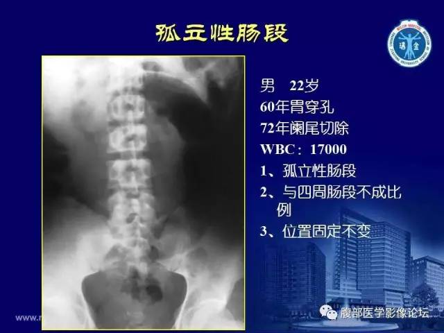 【PPT】急腹症