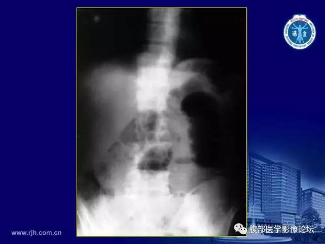 【PPT】急腹症