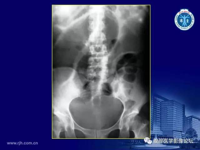 【PPT】急腹症