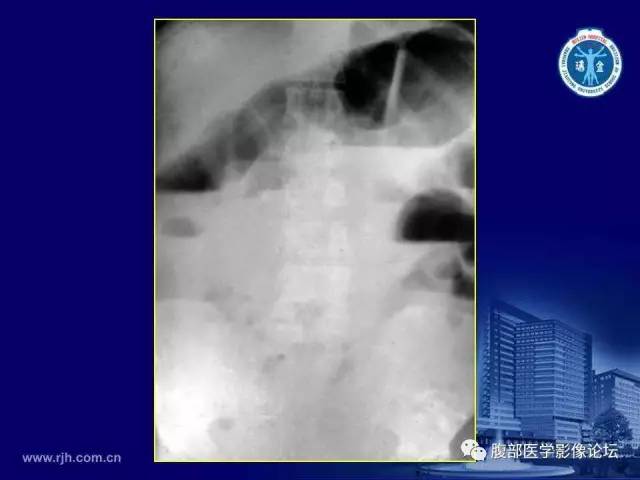 【PPT】急腹症