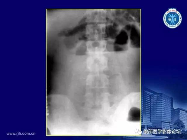 【PPT】急腹症