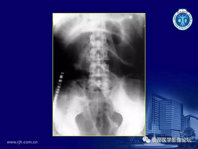 【PPT】急腹症