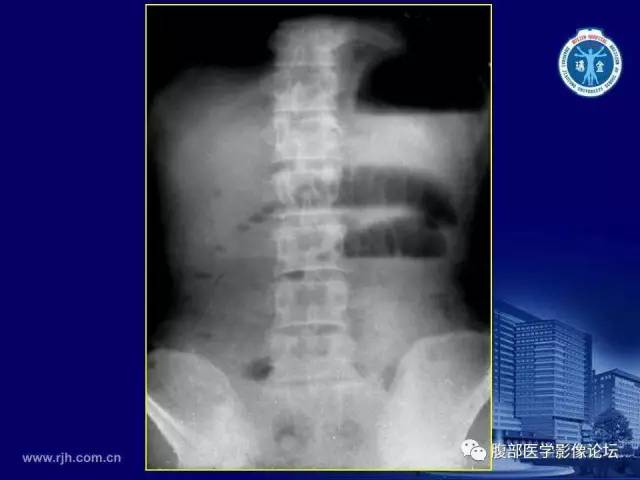 【PPT】急腹症