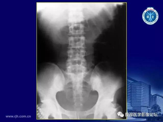 【PPT】急腹症
