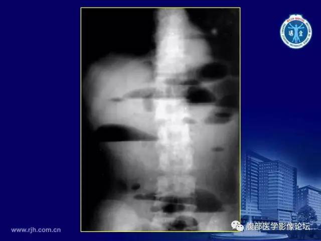 【PPT】急腹症