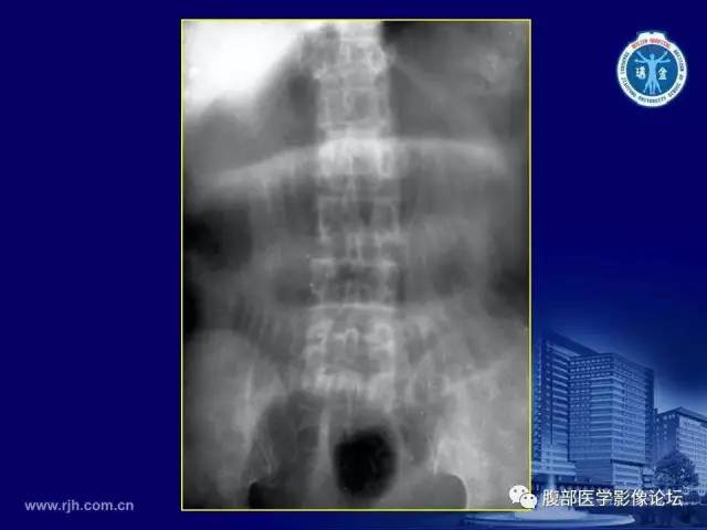 【PPT】急腹症