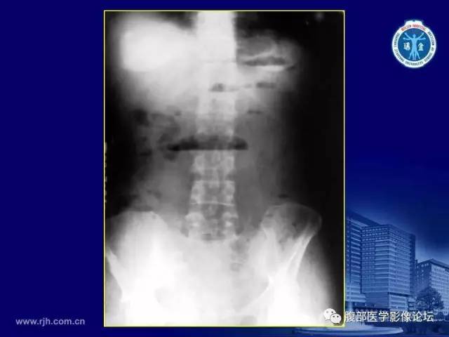 【PPT】急腹症