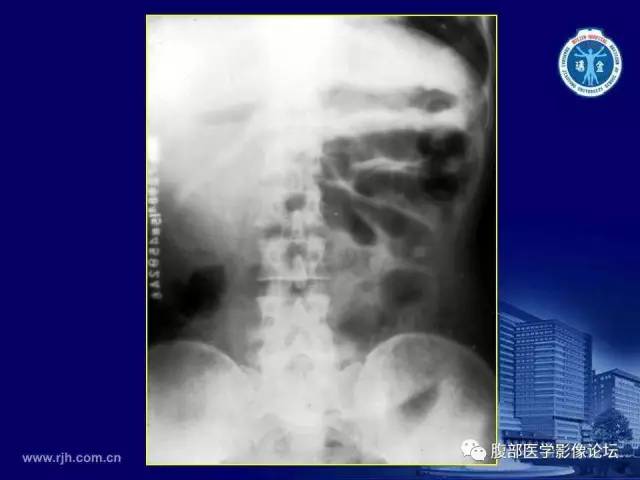 【PPT】急腹症
