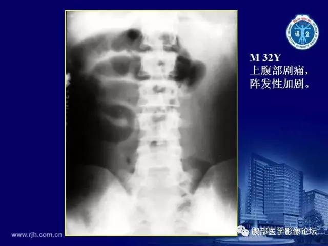 【PPT】急腹症