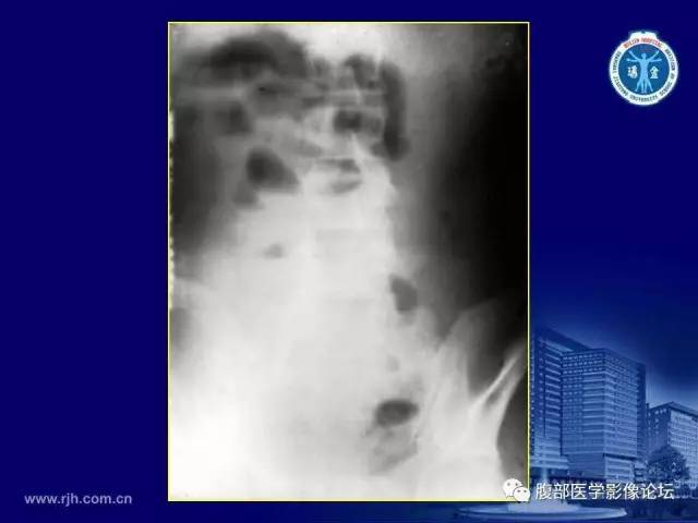【PPT】急腹症