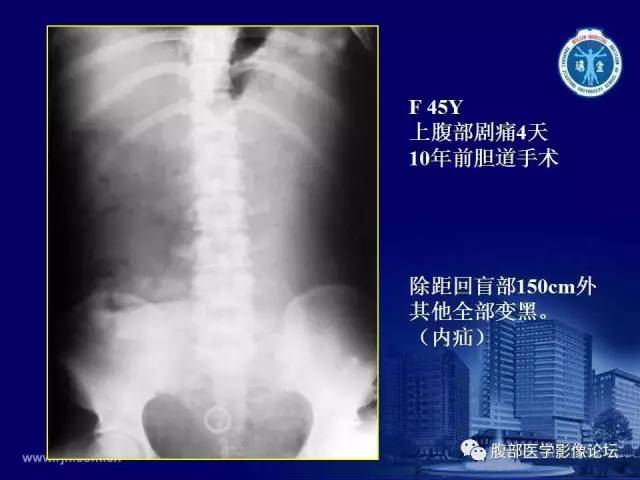 【PPT】急腹症