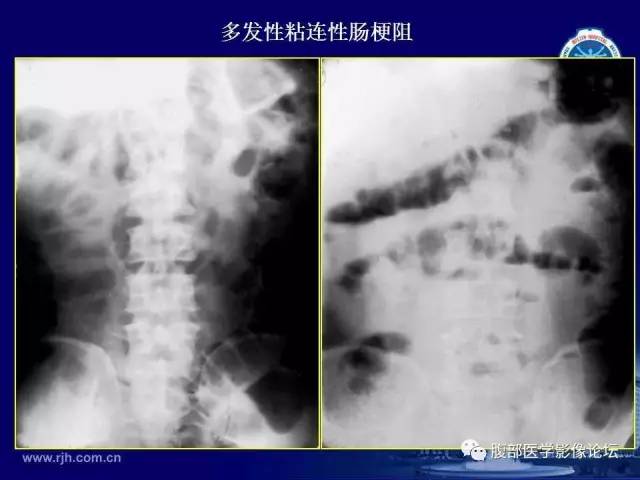 【PPT】急腹症