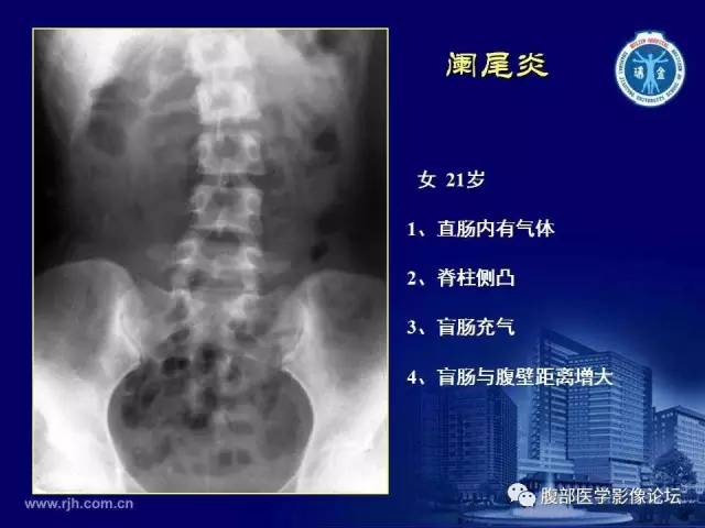 【PPT】急腹症