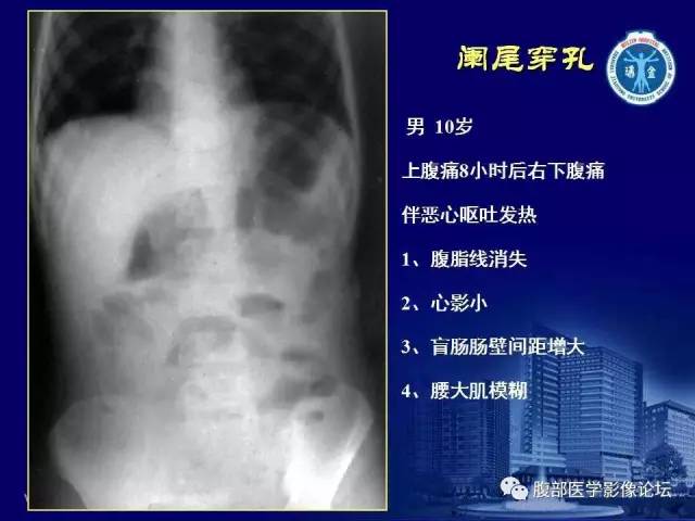 【PPT】急腹症