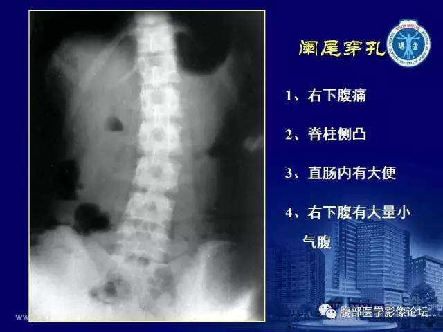 【PPT】急腹症