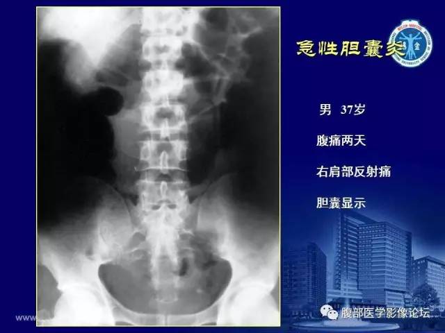【PPT】急腹症