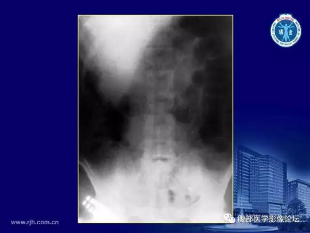【PPT】急腹症