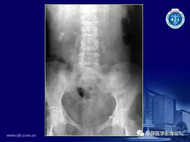 【PPT】急腹症