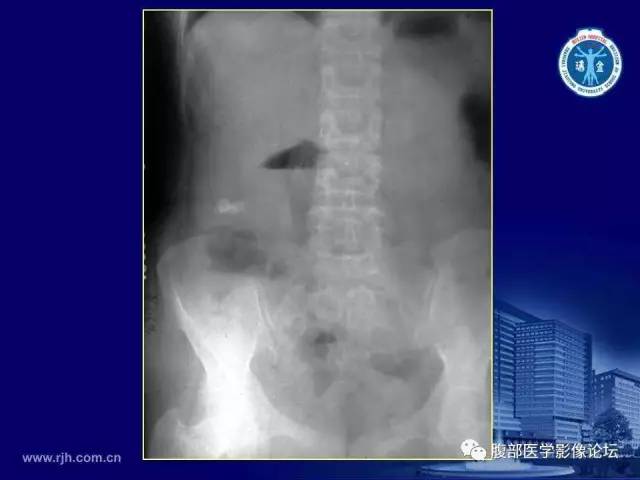【PPT】急腹症