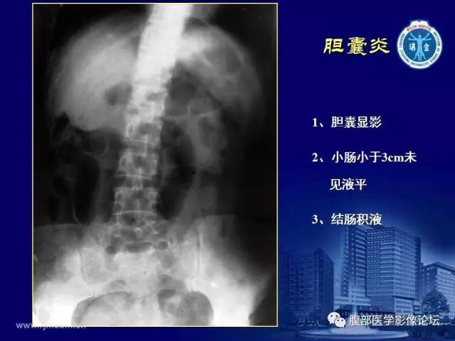 【PPT】急腹症