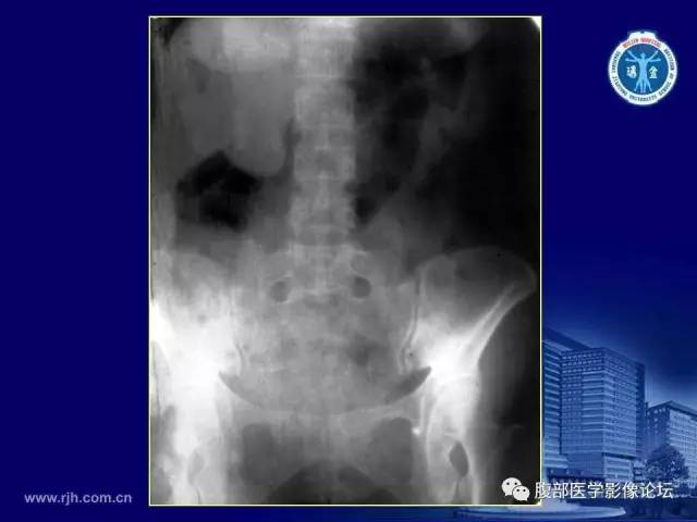 【PPT】急腹症