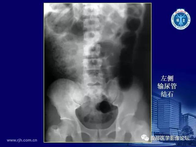 【PPT】急腹症