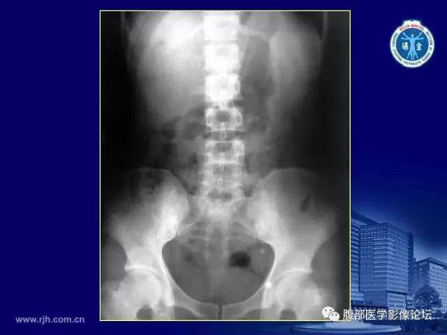 【PPT】急腹症