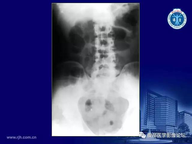 【PPT】急腹症